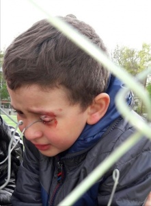 В Саках ребенок чуть не лишился глаза из-за проволоки, торчащей из ограждения школьного стадиона